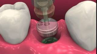 Dental Implant