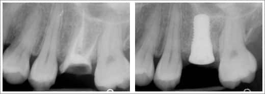 The patient was relaxed during various dental procedures due to the use of sedatives.