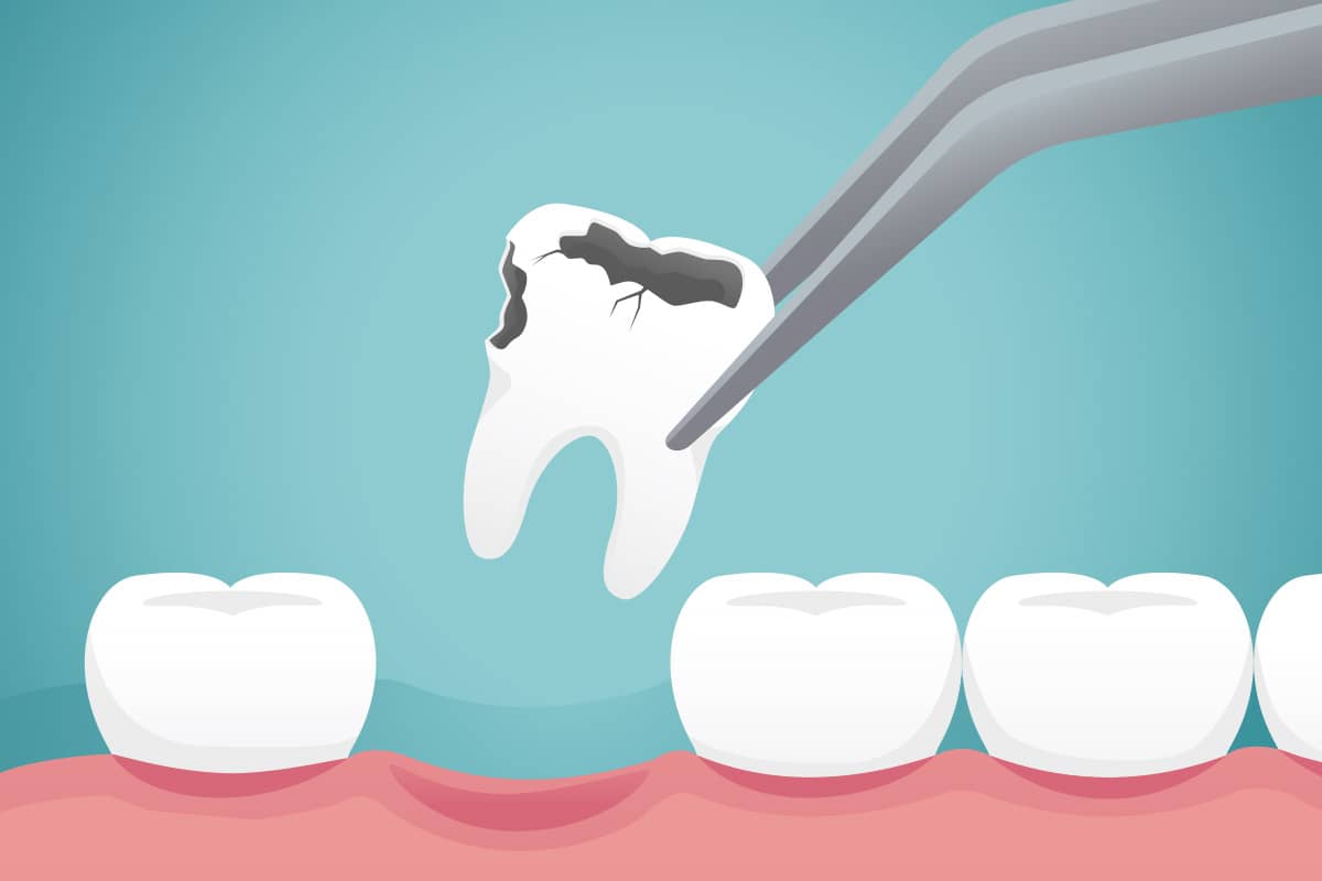 The dangers of not replacing missing teeth
