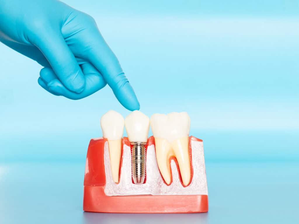 Dental implants are secure to the bone, so swallow them in very uncommon 