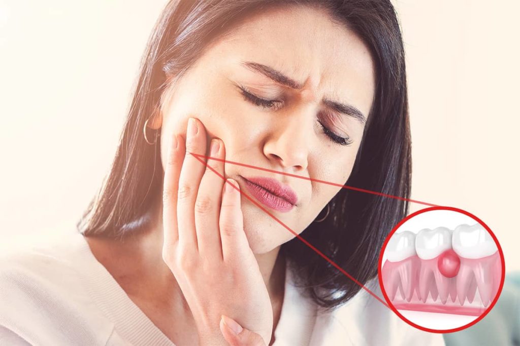 What Are Dental Abscesses?