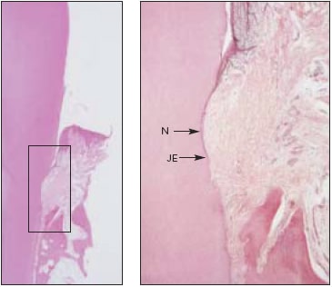 Control tooth treated with scaling and root planing without laser application