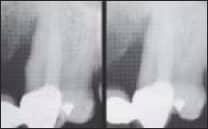 Radiographs of a 54-year-old man with deep infratony defeca on the mesial of torn maxillary canines