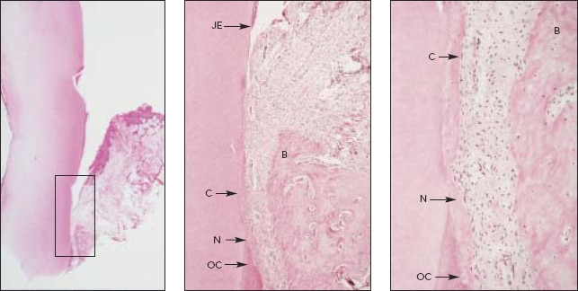 Histologic views of LANAP®-treated maxillary right canine