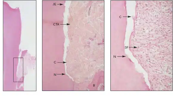  LANAP®-treated mandibular left second premolar of a 48-year-old man