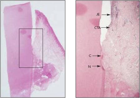 Canine tooth with calculus notch corona/ to bone crest treated with LANAP® 