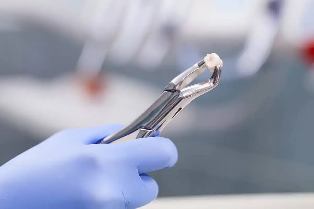 What Happens After a Tooth is Pulled