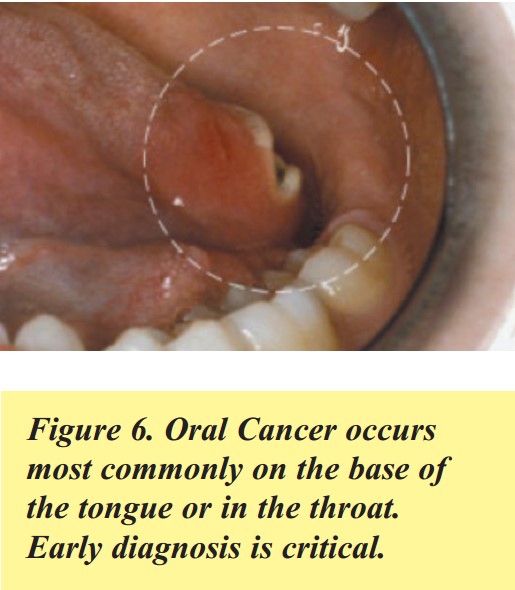 A Concise Guide to Treating Painful Oral Lesions | Miami. FL