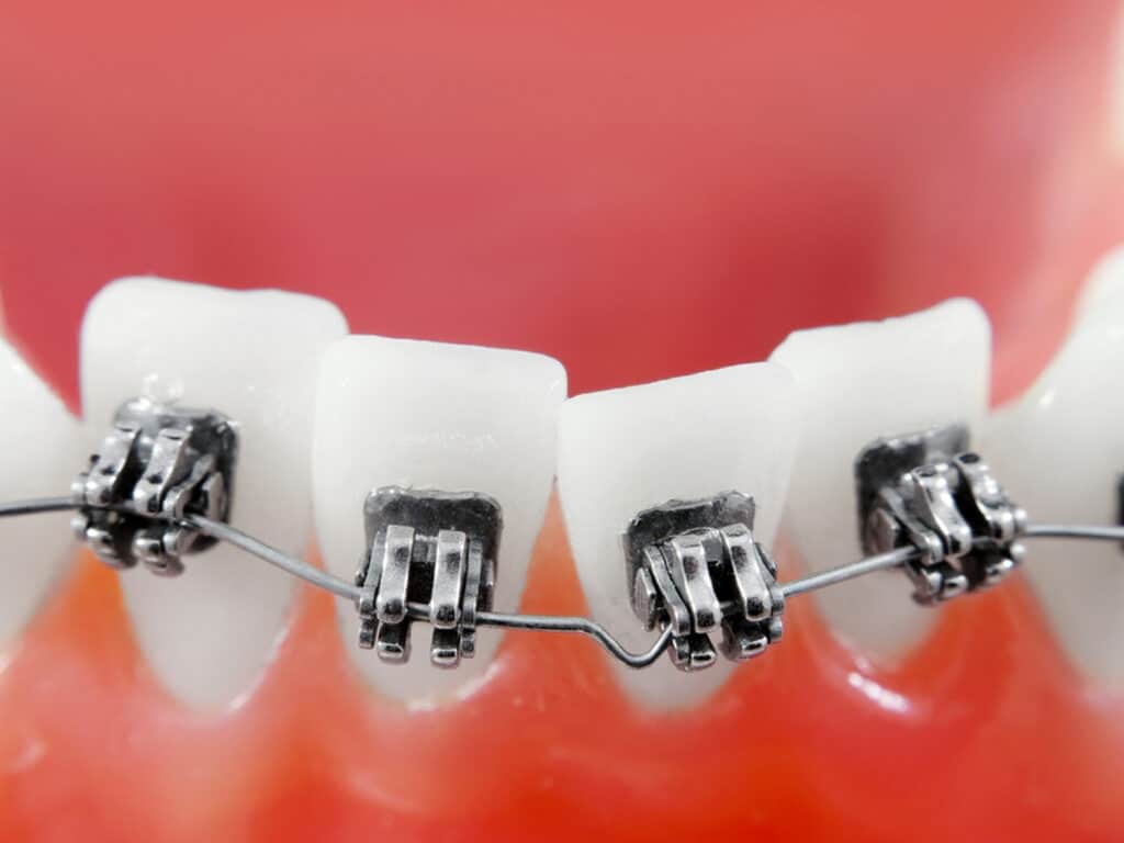 Compared to implants, braces are designed for tooth alignment, while implants can replace natural teeth.