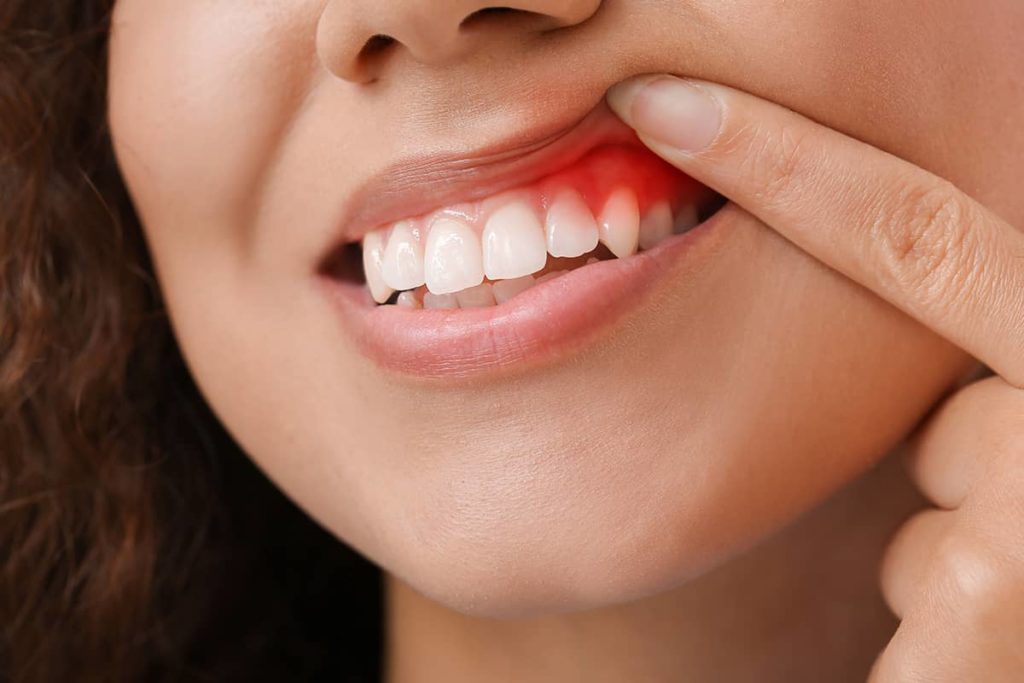 5 Myths About Gum Disease