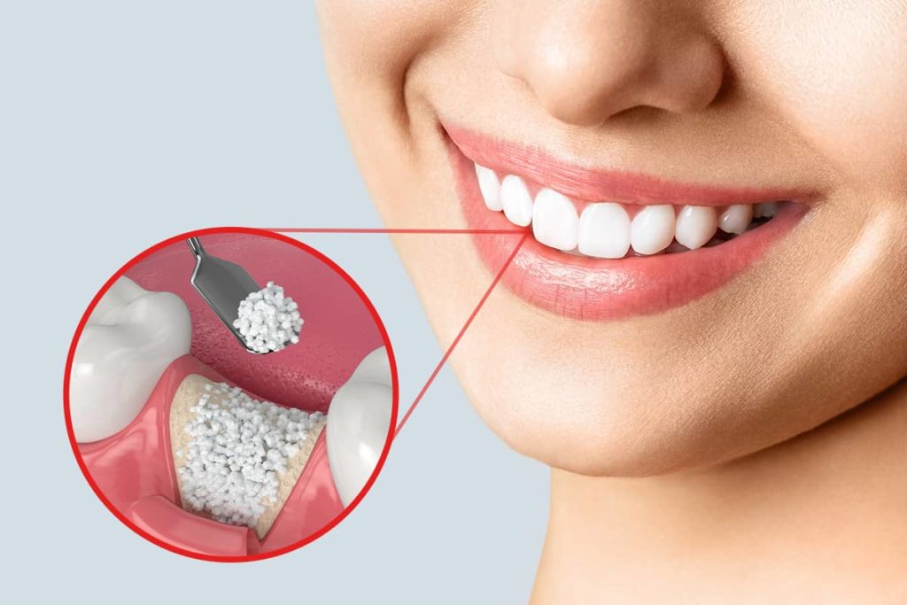 3 Myths about Dental Bone Grafting