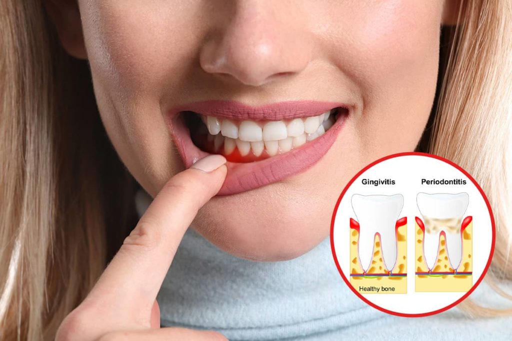 Gum diseases