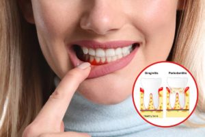 Gum diseases