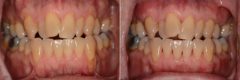 Gum Recession Before and After Photos in Miami, Florida, Patient 266