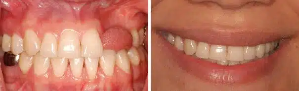 Dental Implants Before and After Photos in Miami, Florida, Patient 120