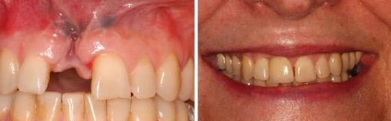 Dental Implants Before and After Photos in Miami, Florida, Patient 117