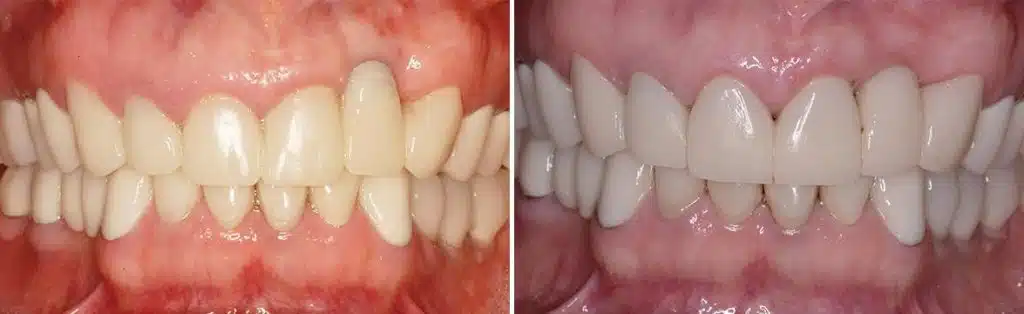 Dental Implants Repair Before and After Photos in Miami, Florida, Patient 134