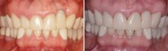 Dental Implants Repair Before and After Photos in Miami, Florida, Patient 134