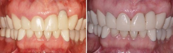 Dental Implants Repair Before and After Photos in Miami, Florida, Patient 134