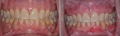 Gum Recession Before and After Photos in Miami, Florida, Patient 143