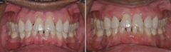 Gum Recession Before and After Photos in Miami, Florida, Patient 146