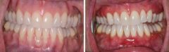 Gum Recession Before and After Photos in Miami, Florida, Patient 149