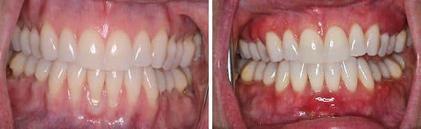 Gum Recession Before and After Photos in Miami, Florida, Patient 149