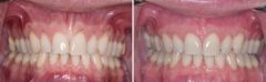 Gum Recession Before and After Photos in Miami, Florida, Patient 155