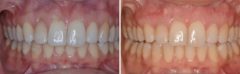 Gum Recession Before and After Photos in Miami, Florida, Patient 161