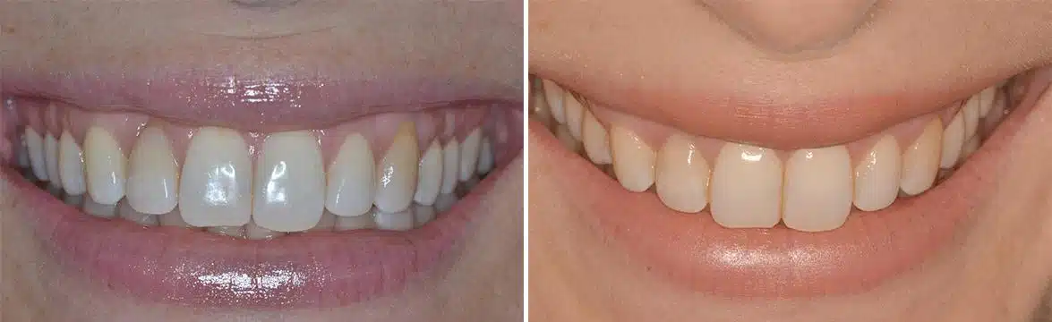 Gum Recession Before and After Photos in Miami, Florida, Patient 161