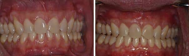 Gum Recession Before and After Photos in Miami, Florida, Patient 137