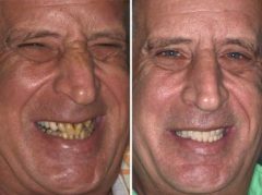 All-on-4 ® Dental Implants Before and After Photos in Miami, Florida, Patient 59