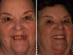 All-on-4 ® Dental Implants Before and After Photos in Miami, Florida, Patient 68