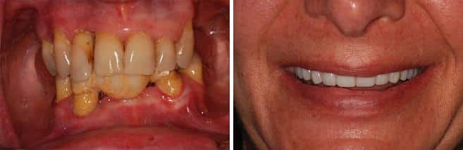 All-on-4 ® Dental Implants Before and After Photos in Miami, Florida, Patient 77