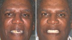 All-on-4 ® Dental Implants Before and After Photos in Miami, Florida, Patient 80