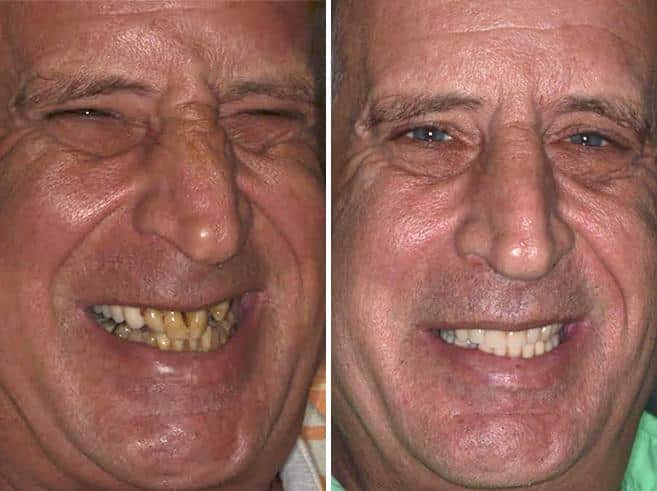 All-on-4 ® Dental Implants Before and After Photos in Miami, Florida, Patient 59