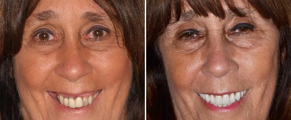 All-on-4 ® Dental Implants Before and After Photos in Miami, Florida, Patient 94