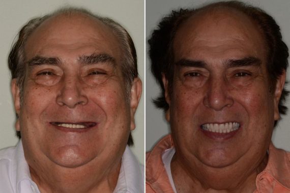 All-on-4 ® Dental Implants Before and After Photos in Miami, Florida, Patient 99