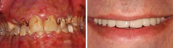 Dental Implants Before and After Photos in Miami, Florida, Patient 123