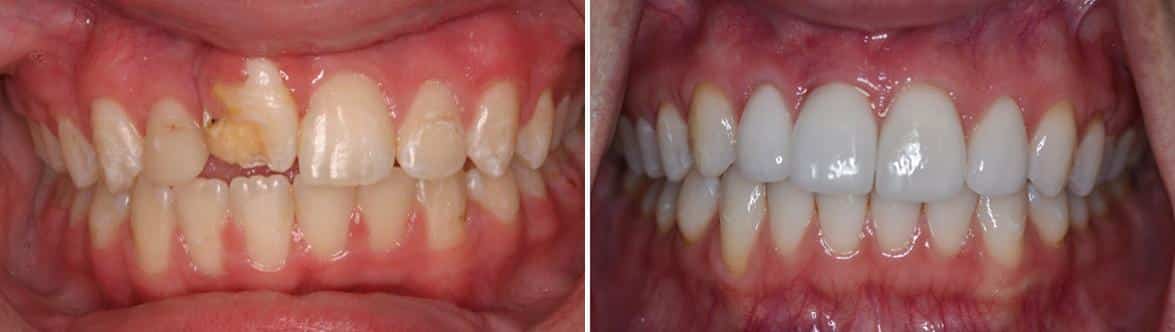 Dental Implants Before and After Photos in Miami, Florida, Patient 126