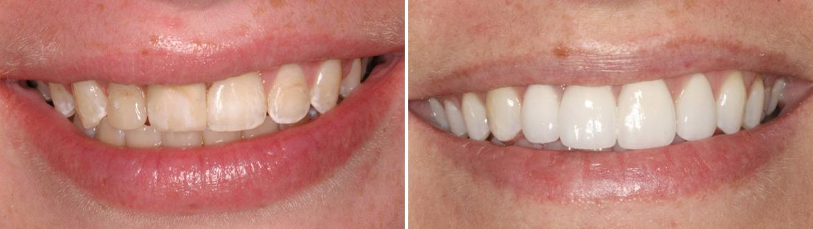 Dental Implants Before and After Photos in Miami, Florida, Patient 126