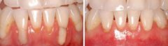 Gum Recession Before and After Photos in Miami, Florida, Patient 140