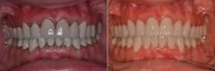 Gum Recession Before and After Photos in Miami, Florida, Patient 166