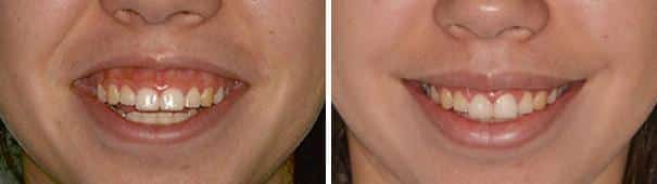 Gummy Smile Correction Before and After Photos in Miami, Florida, Patient 169