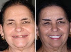 All-on-4 ® Dental Implants Before and After Photos in Miami, Florida, Patient 62