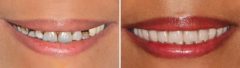 All-on-4 ® Dental Implants Before and After Photos in Miami, Florida, Patient 88