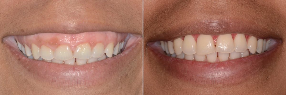 Gummy Smile Correction Before and After Photos in Miami, Florida, Patient 8581