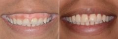 Gummy Smile Correction Before and After Photos in Miami, Florida, Patient 8581