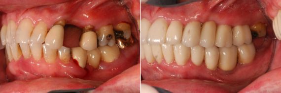 Dental Implants Before and After Photos in Miami, Florida, Patient 8627