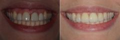 Dental Implants Before and After Photos in Miami, Florida, Patient 8635